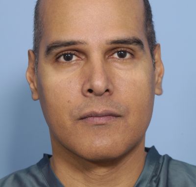 Before Image: Eyelift - front