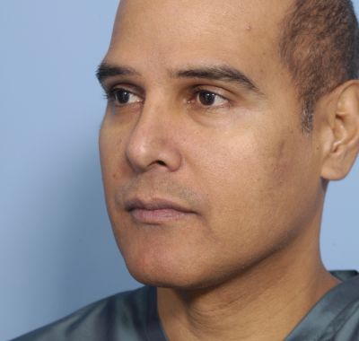 Before Image: Eyelift - left-front-oblique