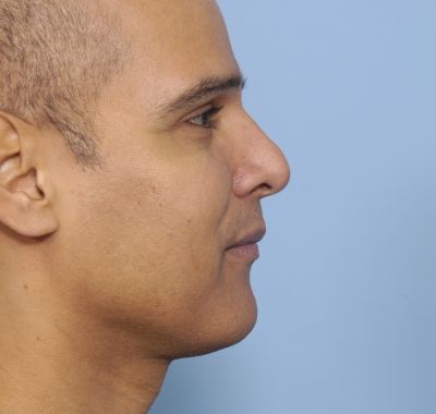 Before Image: Eyelift - right-side