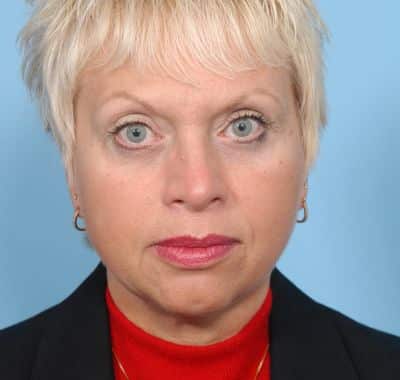 After Image: Eyelift - front