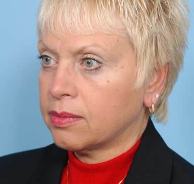 After Image: Eyelift - left-front-oblique