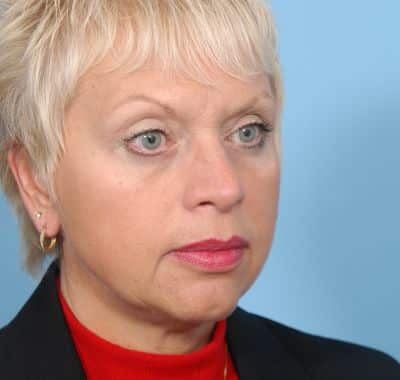 After Image: Eyelift - right-front-oblique