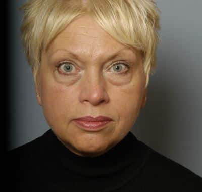 Before Image: Eyelift - front