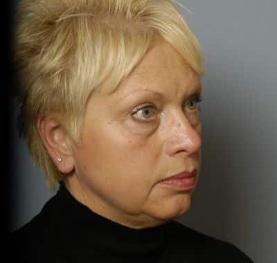 Before Image: Eyelift - right-front-oblique