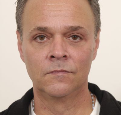 After Image: Eyelift - front