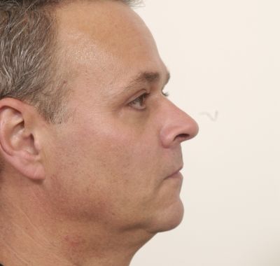 After Image: Eyelift - right-side