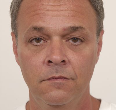 Before Image: Eyelift - front