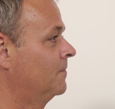 Before Image: Eyelift - right-side