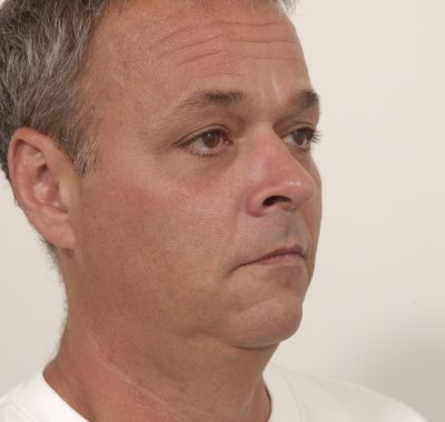 Before Image: Eyelift - right-front-oblique