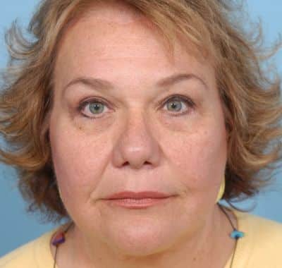 After Image: Eyelift - front