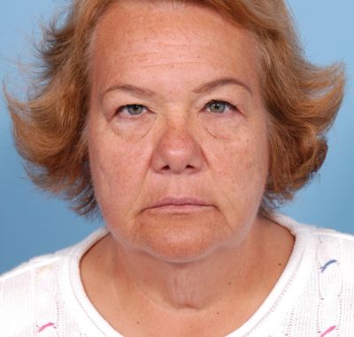 Before Image: Eyelift - front