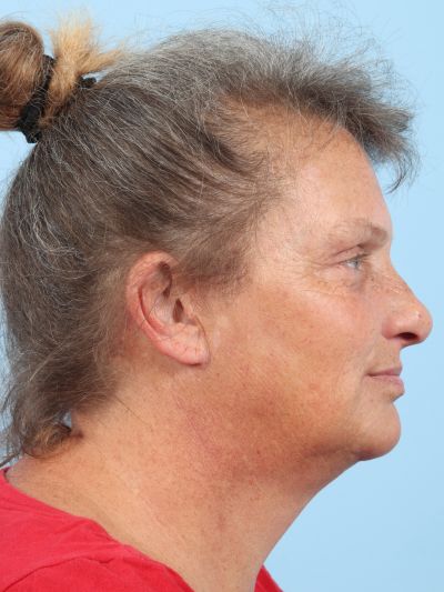 After Image: Facelifts/Necklifts - right-side