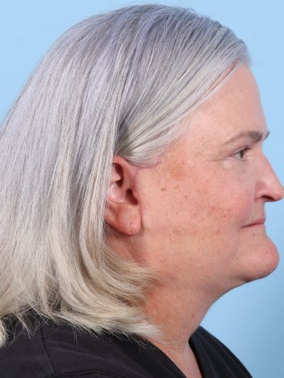 After Image: Facelifts/Necklifts - right-side