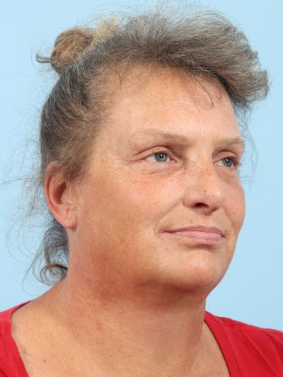 After Image: Facelifts/Necklifts - right-front-oblique