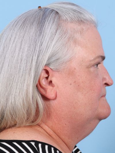 Before Image: Facelifts/Necklifts - right-side