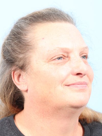 Before Image: Facelifts/Necklifts - right-front-oblique