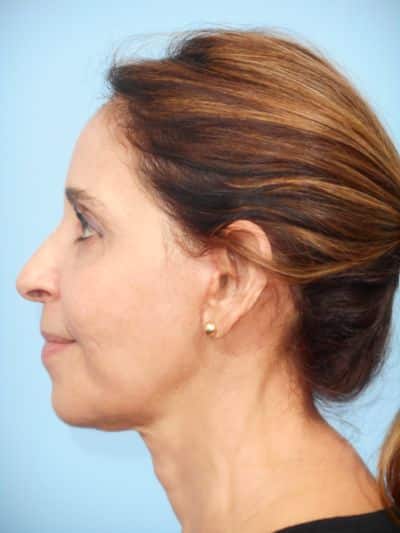 After Image: Facelifts/Necklifts - left-side