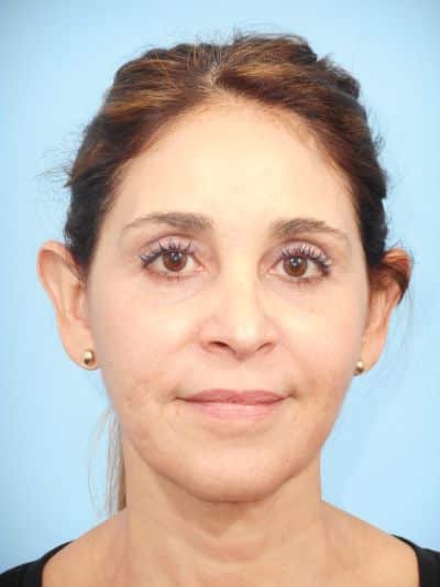 After Image: Facelifts/Necklifts - front