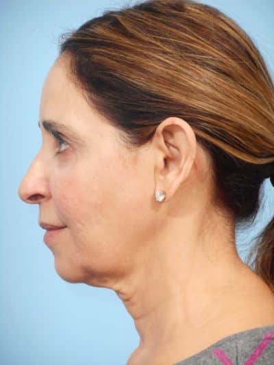 Before Image: Facelifts/Necklifts - left-side
