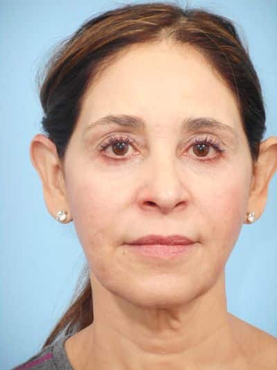 Before Image: Facelifts/Necklifts - front