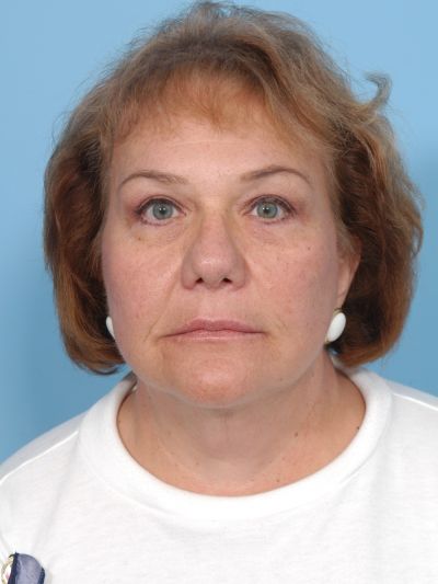 After Image: Facelifts/Necklifts - front