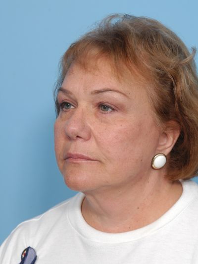 After Image: Facelifts/Necklifts - left-front-oblique