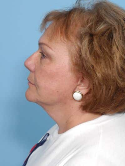 After Image: Facelifts/Necklifts - left-side