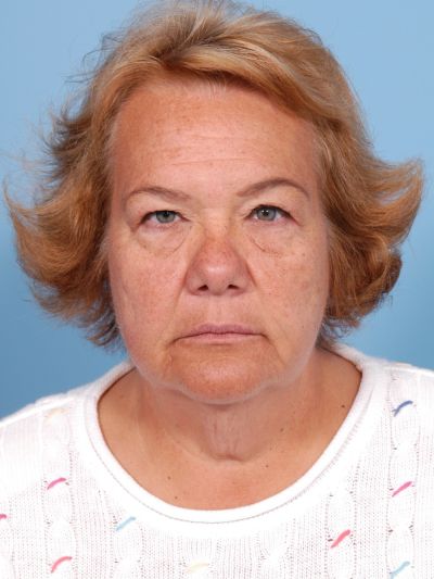 Before Image: Facelifts/Necklifts - front