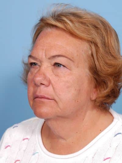 Before Image: Facelifts/Necklifts - left-front-oblique