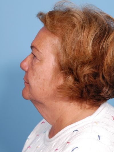 Before Image: Facelifts/Necklifts - left-side