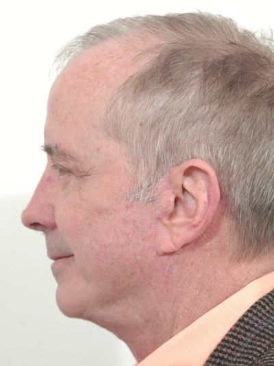 After Image: Facelifts/Necklifts - left-side