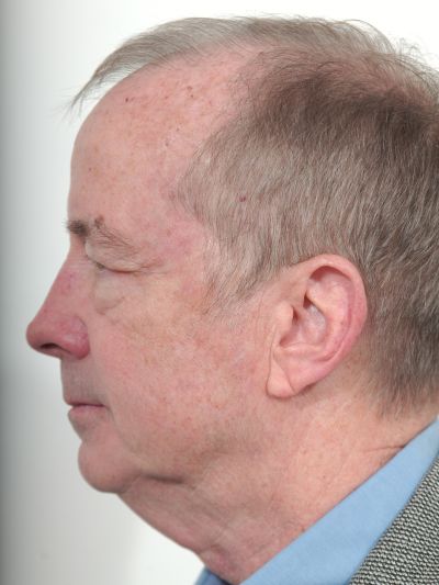 Before Image: Facelifts/Necklifts - left-side