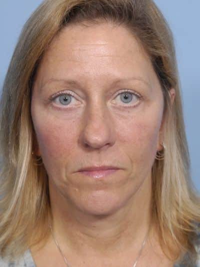 After Image: Facelifts/Necklifts - front