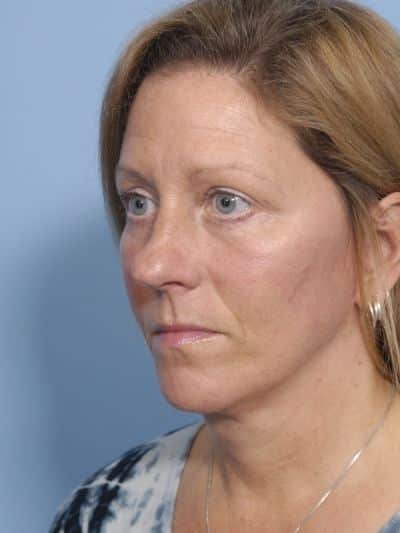 After Image: Facelifts/Necklifts - left-front-oblique