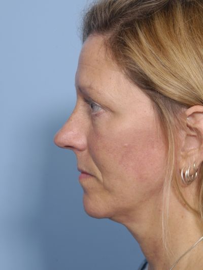 After Image: Facelifts/Necklifts - left-side