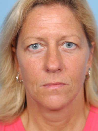 Before Image: Facelifts/Necklifts - front