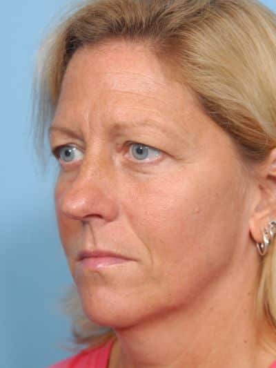 Before Image: Facelifts/Necklifts - left-front-oblique