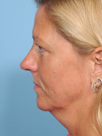 Before Image: Facelifts/Necklifts - left-side