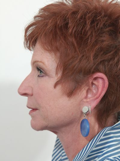 After Image: Facelifts/Necklifts - left-side