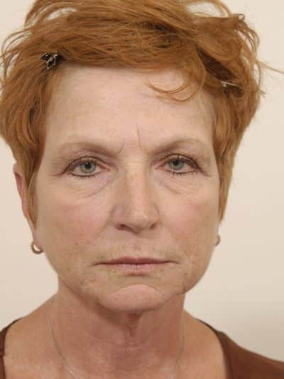 Before Image: Facelifts/Necklifts - front