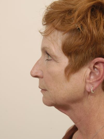 Before Image: Facelifts/Necklifts - left-side