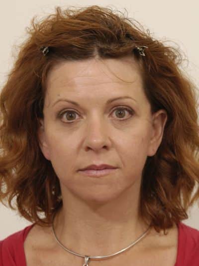 After Image: Facelifts/Necklifts - front