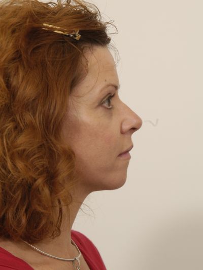 After Image: Facelifts/Necklifts - right-side