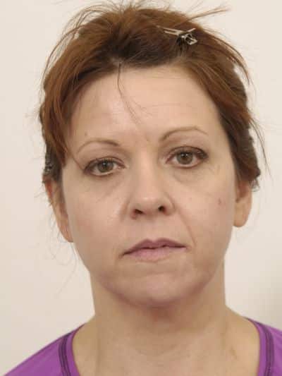 Before Image: Facelifts/Necklifts - front