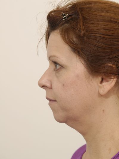 Before Image: Facelifts/Necklifts - left-side