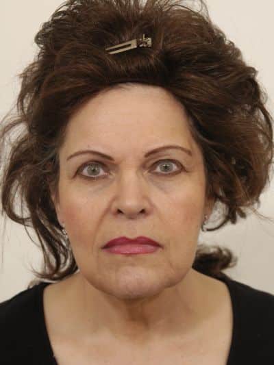 Before Image: Facelifts/Necklifts - front