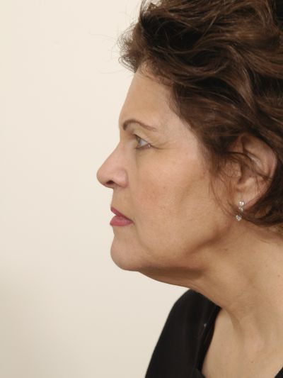 Before Image: Facelifts/Necklifts - left-side
