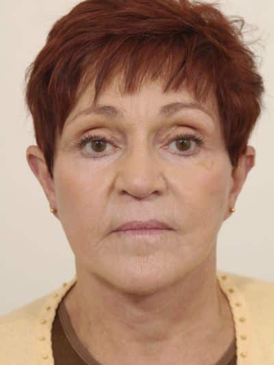 After Image: Facelifts/Necklifts - front