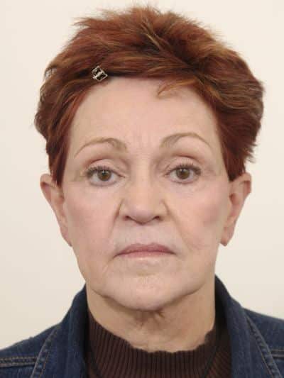Before Image: Facelifts/Necklifts - front