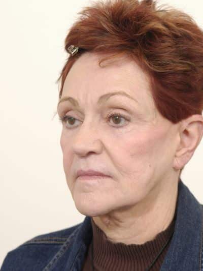 Before Image: Facelifts/Necklifts - left-front-oblique